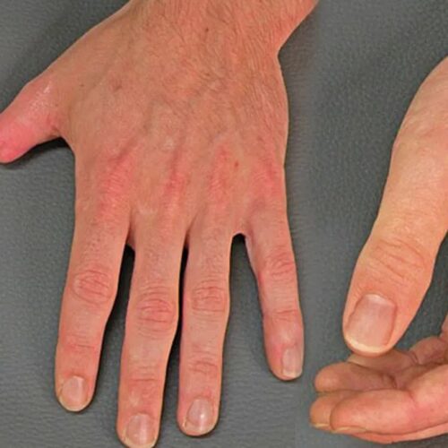 Prótesis hiperrealistas