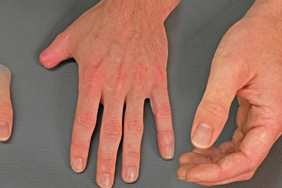 Prótesis hiperrealistas