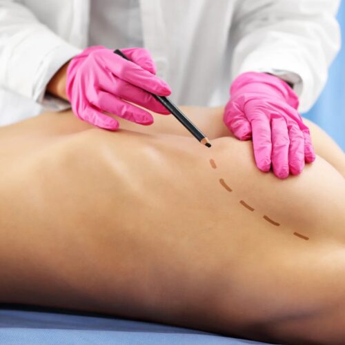 Reconstrucción de mama con prótesis