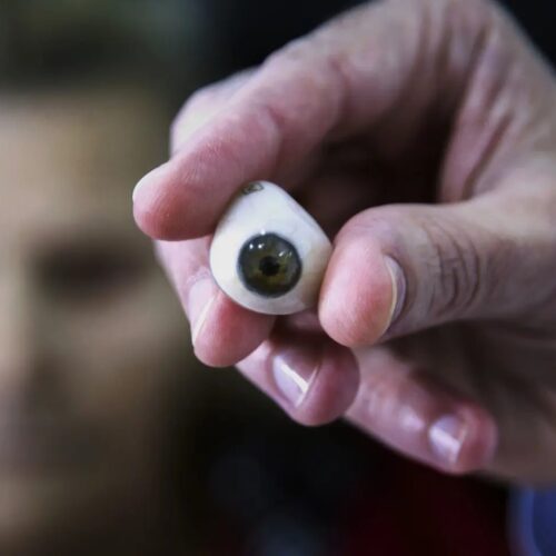 famosos con prótesis ocular