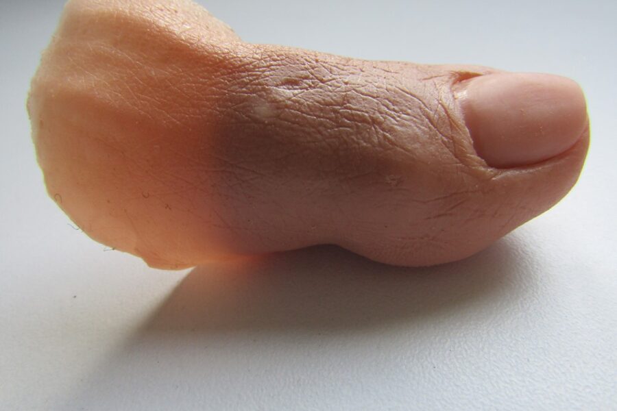 Prótesis de dedos del pie