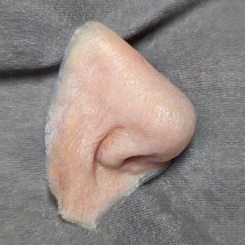 Epítesis nasal tras cirugía de cáncer