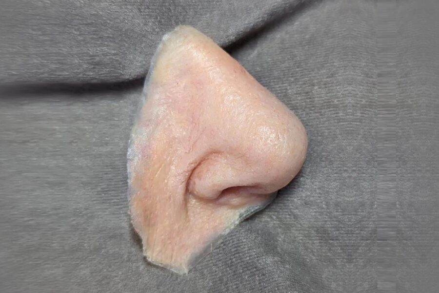 Epítesis nasal tras cirugía de cáncer