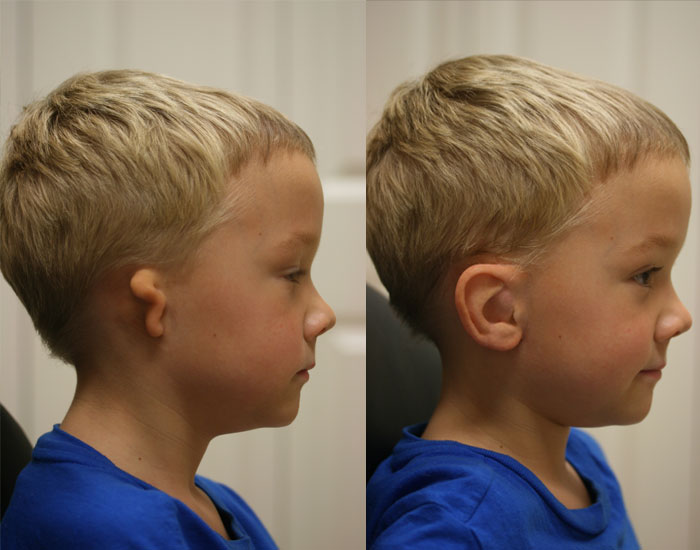Microtia en niños