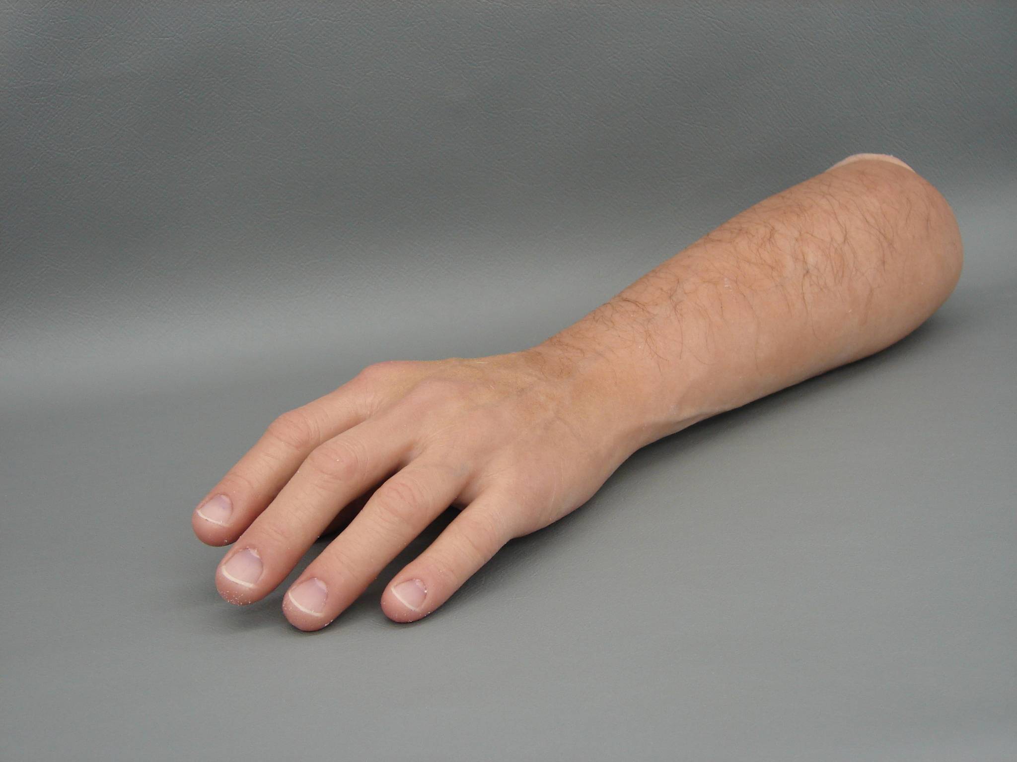 Prótesis de mano tras amputación laboral