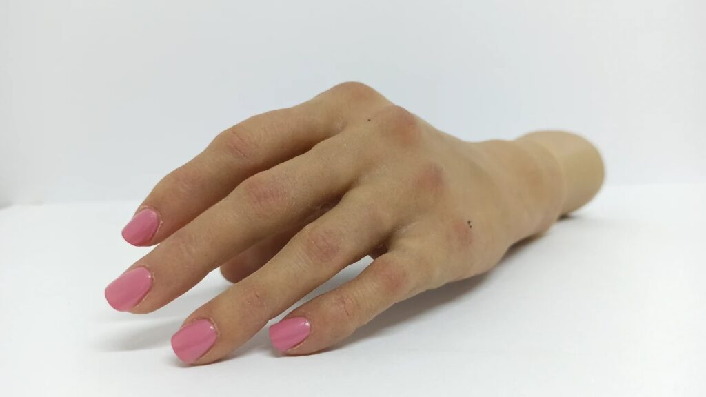 Prótesis de mano tras amputación laboral